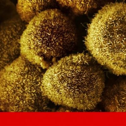 Vacinas contra cancro baseadas em ARNm avançam, mesmo com cortes de fundos