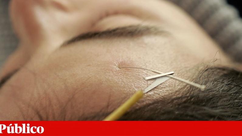 A acupuntura é uma das técnicas mais presentes nas ofertas dos centros de "medicina integrativa"
