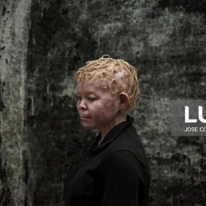 Associações moçambicanas pedem isenções de protetor solar para albinos