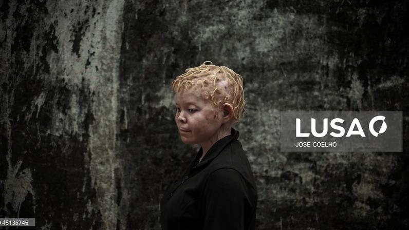 Associações moçambicanas pedem isenções de protetor solar para albinos