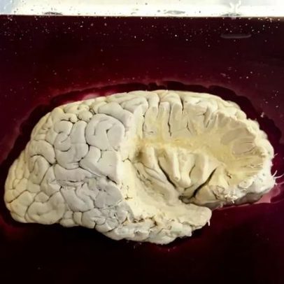SNS vai receitar fármacos para cancro cerebral e doença neurodegenerativa