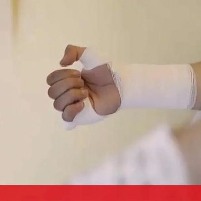Mulheres entre 40 e 70 anos são mais afetadas pela síndrome do túnel carpiano