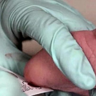 Nove em cada dez com doença do pezinho sem apoio domiciliário do sistema de saúde