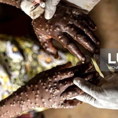 Guiné-Bissau regista primeiro caso de mpox e apela à vigilância