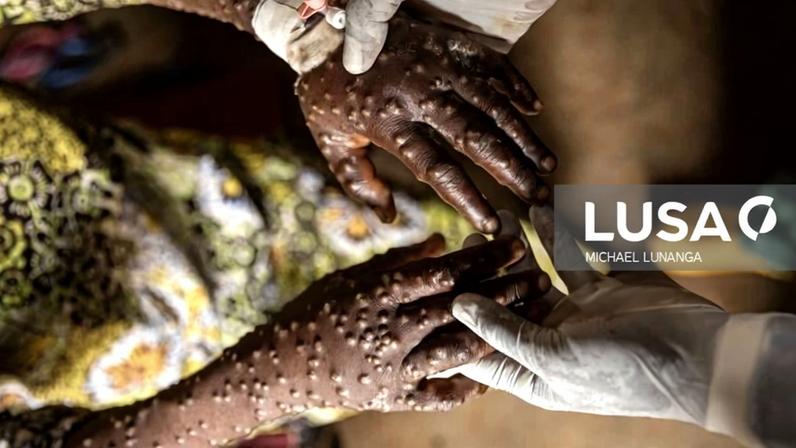 Guiné-Bissau confirma primeiro caso de mpox e apela à vigilância da população